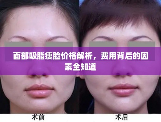 面部吸脂瘦脸价格解析，费用背后的因素全知道